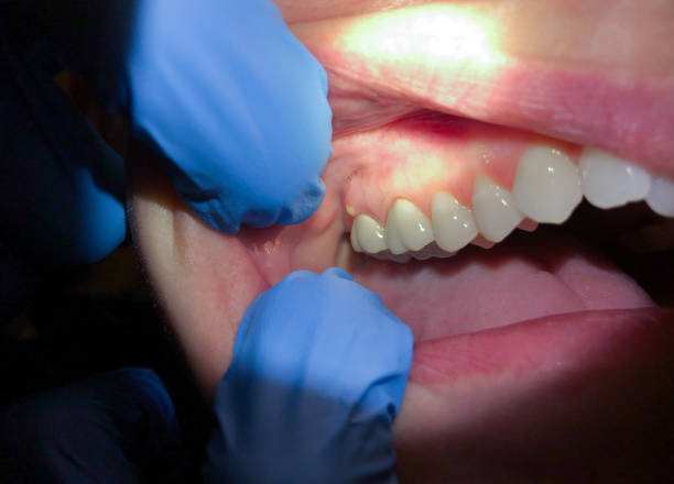 Best Broken Tooth Emergency  in Blue Mound, IL